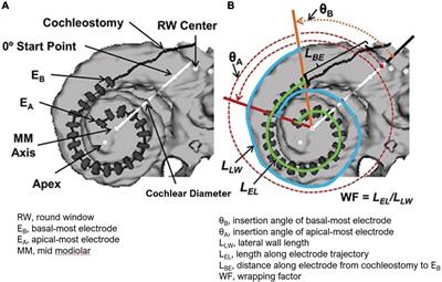 Is Characteristic Frequency Limiting Real-Time Electrocochleography During Cochlear Implantation?
